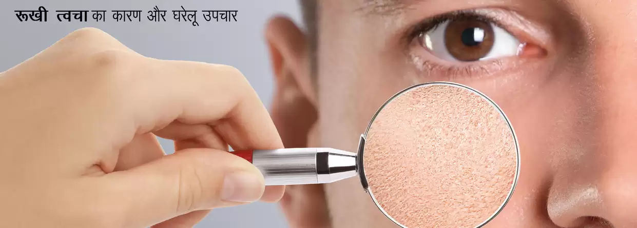 रूखी त्वचा का कारण और घरेलू उपचार : Causes and home remedies for Dry Skin